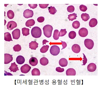 미세혈관병성 용혈성 빈혈