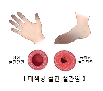 폐색성 혈전 혈관염