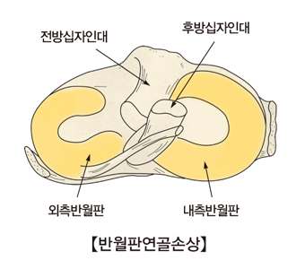 반월판 연골손상
