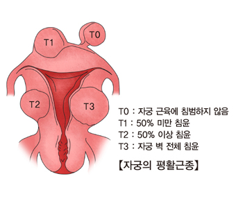 자궁의 평활근종
