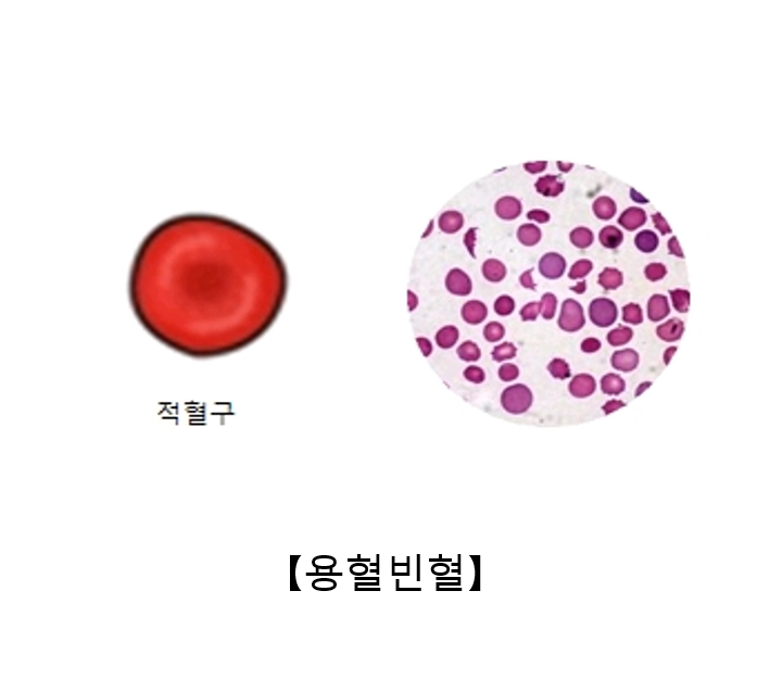 용혈빈혈