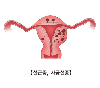 선근증, 자궁선종
