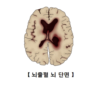 뇌출혈