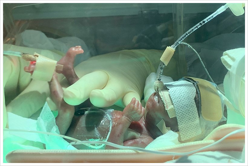 출생체중 288g으로 태어난 건우가 서울아산병원 신생아중환자실 인큐베이터에서 치료를 받고 있다(태어난 지 4일째 모습).